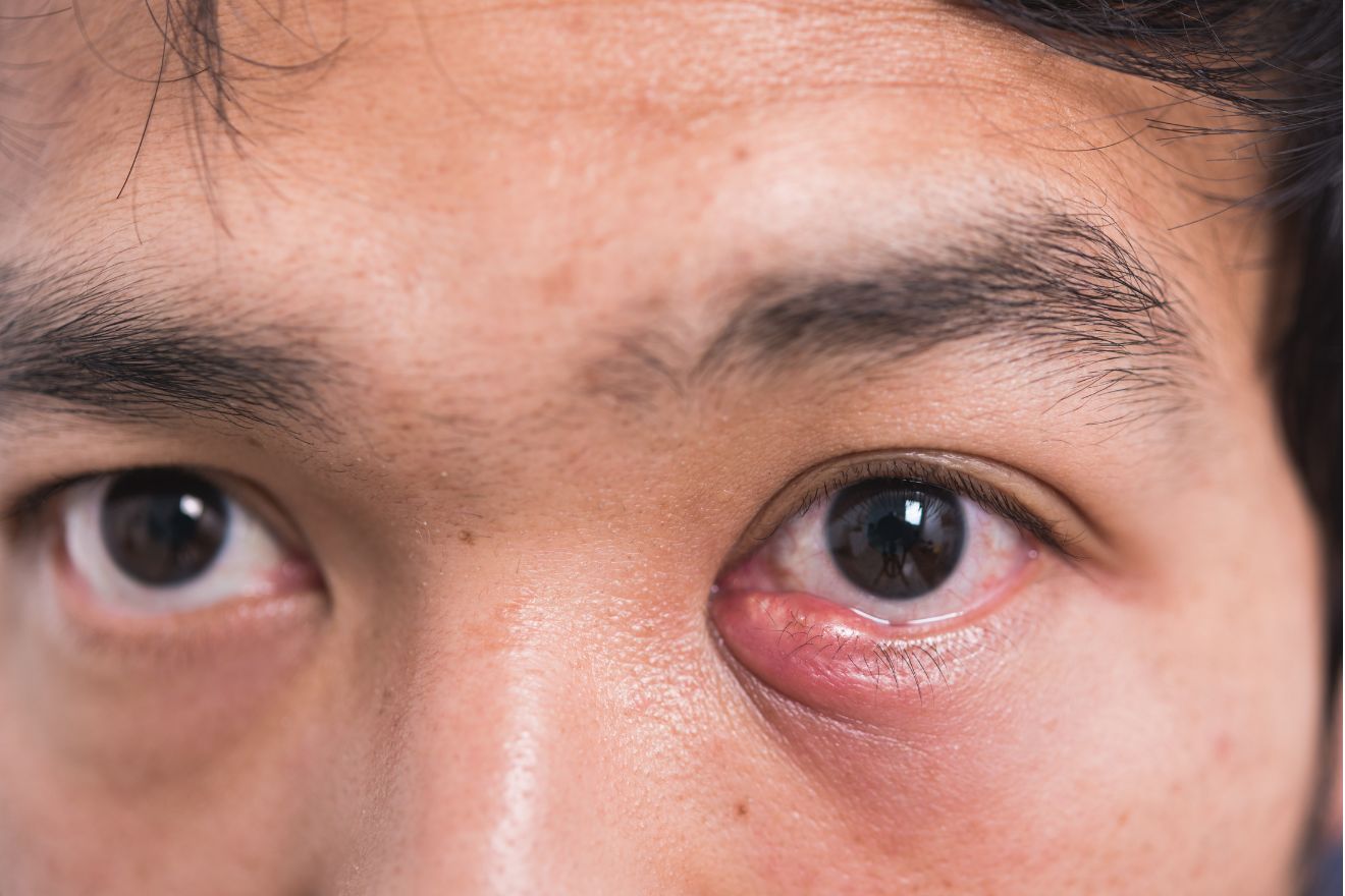 Sty Face How to Treat and Prevent Styes – Brickell Men's Products® CANADA